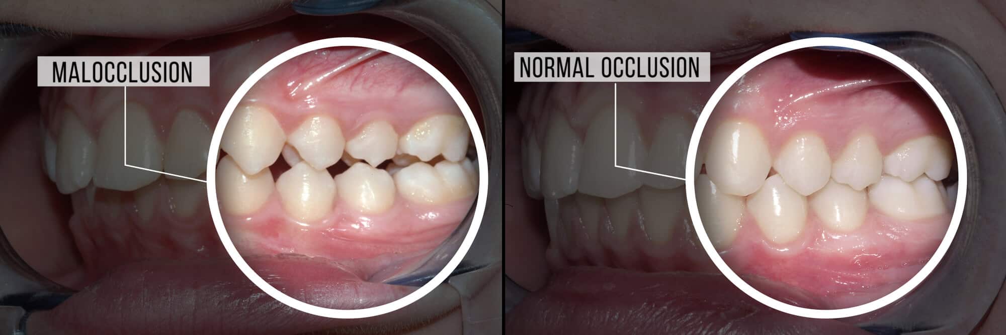 Malocclusion dentaire types et solutions
