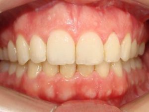 Articulé croisé Invisalign