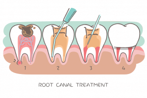 le traitement de la dent nécrosée se fait en plusieurs étapes.