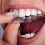 23425Carie dentaire : les causes, symptômes et traitements courants