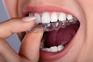 cire orthodontique et gouttières