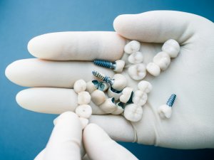 mutuelle implant dentaire