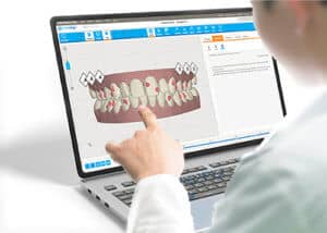 ClinCheck Invisalign taquets