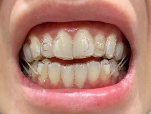 élastiques Invisalign