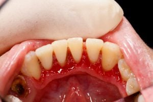 gingivite et parodontite