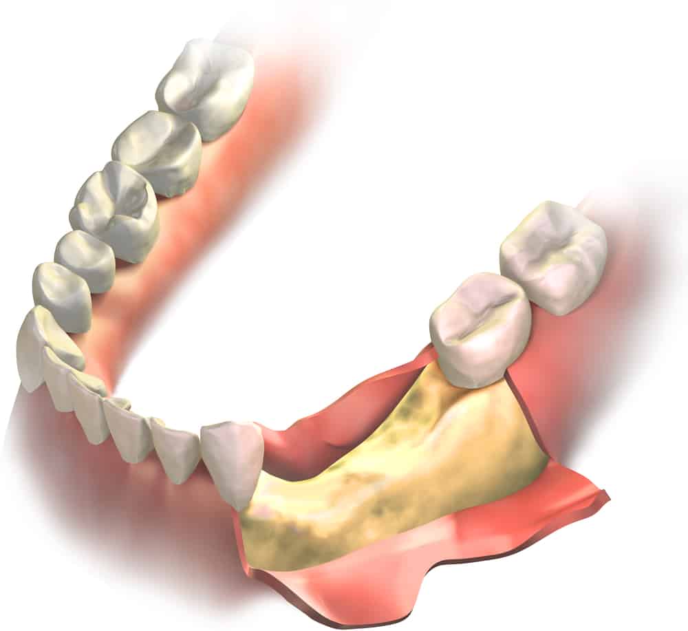 Greffe osseuse dentaire le bon plan pour vos implants
