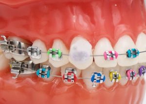 cire orthodontique