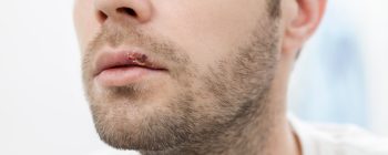 Close-up of a young man's face showing a sore on his lower lip, with stubble and a neutral background.