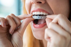 Invisalign et perte de poids