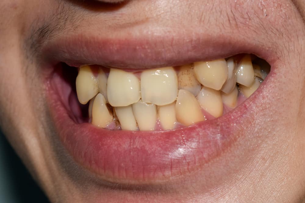 Dents qui se chevauchent causes, prix et solutions Dentaly