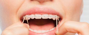 Close-up of a person using orthodontic rubber bands with clear braces, demonstrating dental care and alignment adjustment.