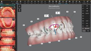 Clincheck Invisalign