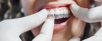 aligneur dentaire dentiste