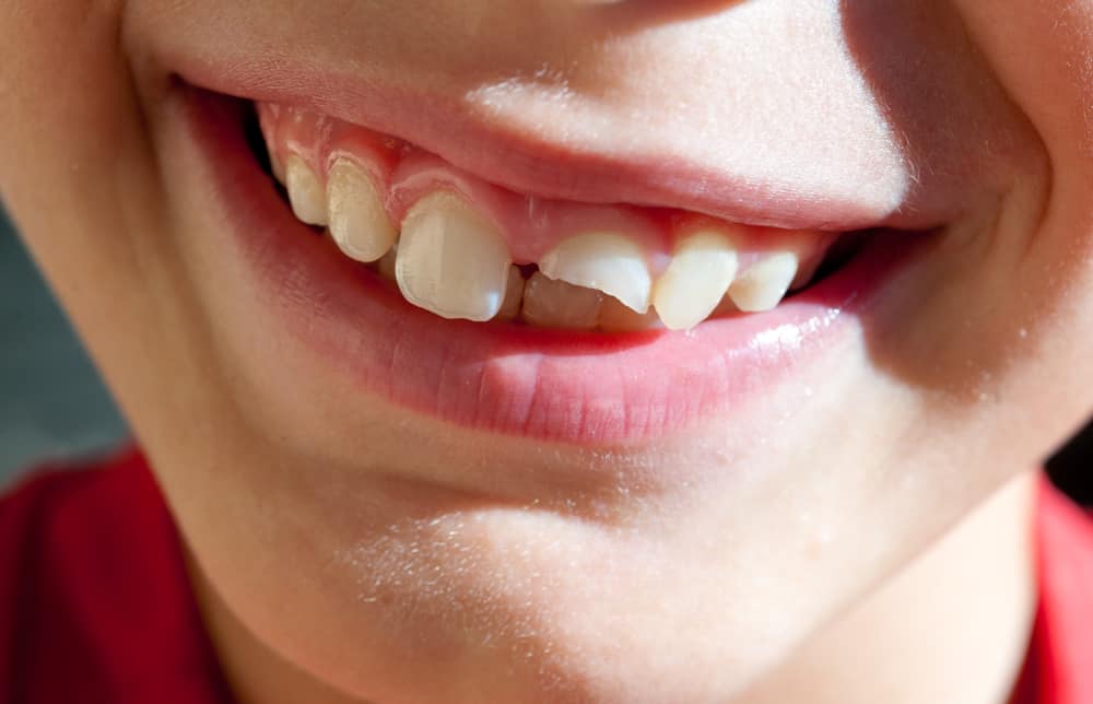 Dent cassée comment réagir en attendant le dentiste
