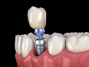 temps de cicatrisation d'un implant