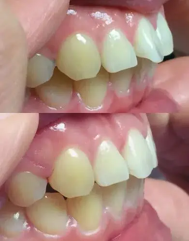 joovence dents en avant