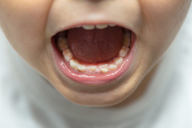 Eruption dentaire les anomalies de l