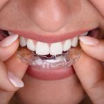 23058Temps de cicatrisation d’un implant dentaire