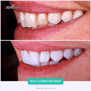 Refaire les dents clinique dentaire istanbul