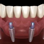 42336Le jet dentaire Oral B Professional Care Waterjet : test et avis