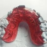 43669Extraction dentaire : pourquoi se faire arracher une dent ?