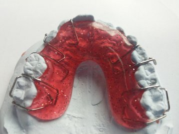 appareil dentaire au palais